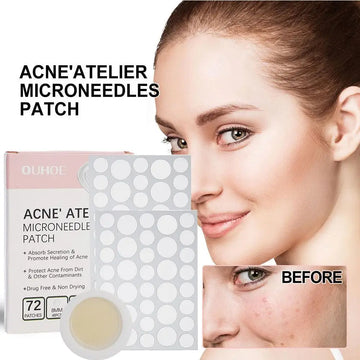 72pcs Acne Patches – Invisible Spot & Blemish Treatment